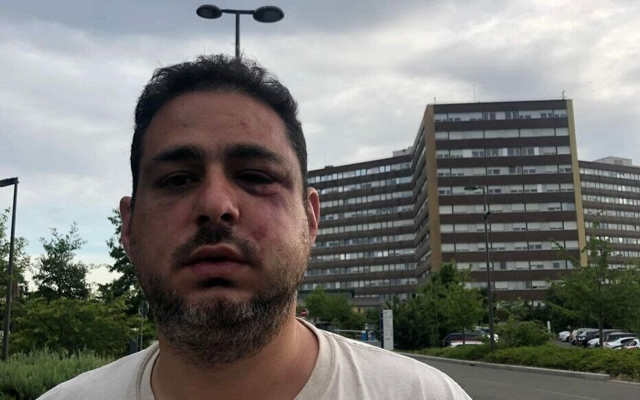 Audrey Rozenhaft uploaded a photo of her husband Liron after he was beaten in Strasbourg, France, June 2, 2022. (Courtesy of Audrey Rozenhaft)