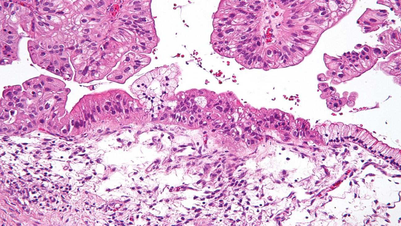 Magnified image of an ovarian tumor.